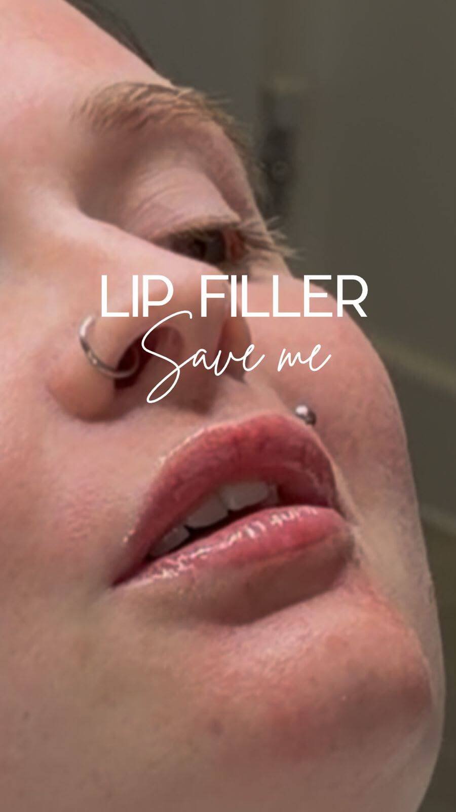 Lip treatment result